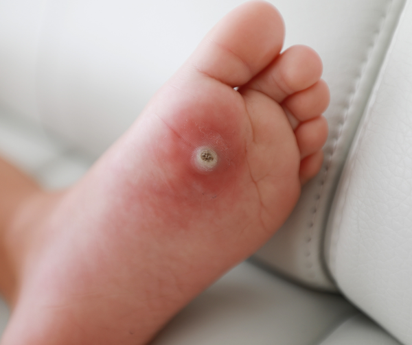 CryoPRobe Wart Treatment